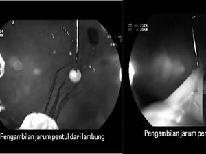 Detik-detik Dokter Senior FKUI Keluarkan Jarum Pentul dari Lambung