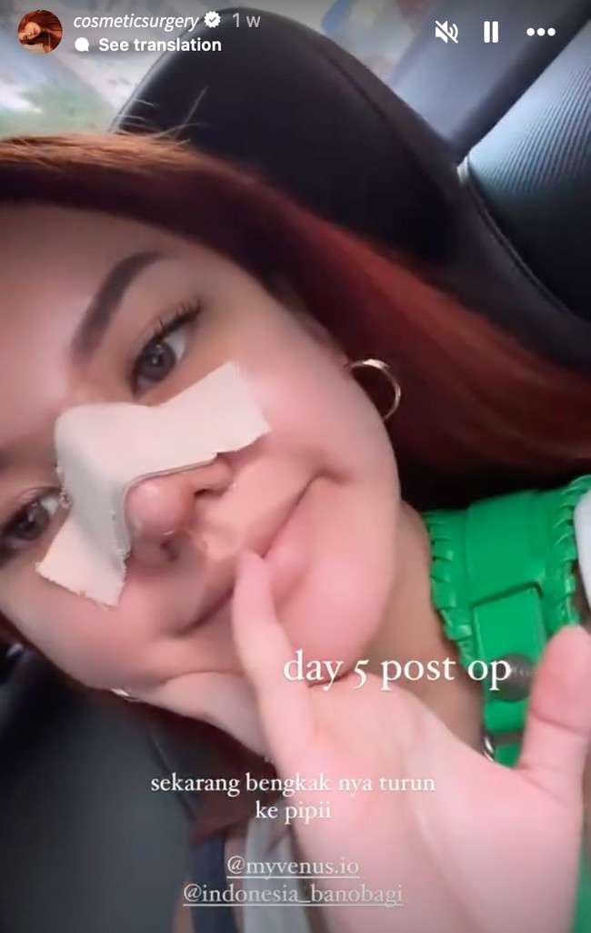 Meski mengaku tak merasa sakit setelah menjalani operasi tersebut, namun dari unggahan yang dibagikan terlihat beberapa hari setelah oplas wajah Shafa masih bengkak. Foto: Instagram/@shafaharris