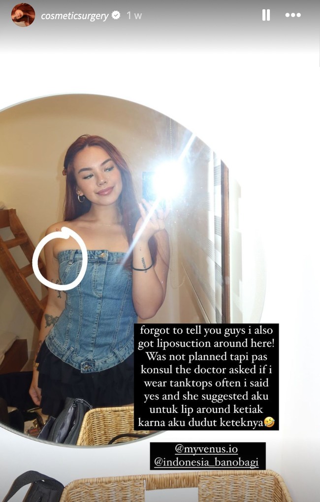 Tak hanya bagian hidung, Shafa juga mengungkapkan jika dirinya sekaligus menjalani oplas payudara serta sedot lemak. Sedot lemak tersebut dilakukan di area sekitar ketiaknya. Foto: Instagram/@shafaharris