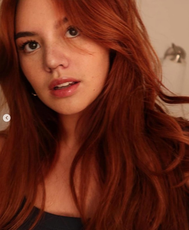 Penampilan Shafa Harris 1 minggu setelah operasi plastik. Ia mengungkapkan jika penyembuhannya itu berbeda-beda, bisa memakan waktu beberapa minggu hingga bulan. Namun hasil akhirnya baru akan terlihat setelah 6 bulan hingga 1 tahun setelah oplas. Foto: Instagram/@shafaharris