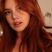 Penampilan Shafa Harris 1 minggu setelah operasi plastik. Ia mengungkapkan jika penyembuhannya itu berbeda-beda, bisa memakan waktu beberapa minggu hingga bulan. Namun hasil akhirnya baru akan terlihat setelah 6 bulan hingga 1 tahun setelah oplas. Foto: Instagram/@shafaharris