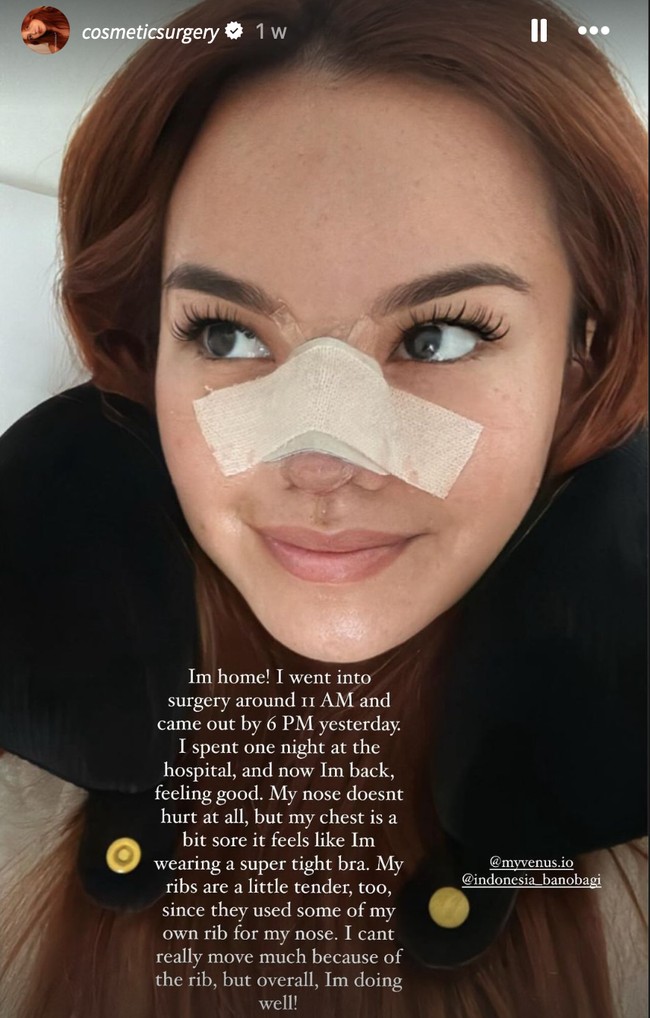 Melalui akun Instagram pribadinya Shafa Harris membagikan perjalanan operasi plastiknya di Korea. Salah satu bagian wajahnya yang dioperasi ialah bagian hidung. Ia mengaku menggunakan tulang rusuknya sendiri untuk memperbaiki bagian hidungnya tersebut. Foto: Instagram/@shafaharris