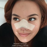 Melalui akun Instagram pribadinya Shafa Harris membagikan perjalanan operasi plastiknya di Korea. Salah satu bagian wajahnya yang dioperasi ialah bagian hidung. Ia mengaku menggunakan tulang rusuknya sendiri untuk memperbaiki bagian hidungnya tersebut. Foto: Instagram/@shafaharris