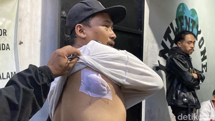Musyafa Akbar Faisal saat memperlihatkan luka tembak di punggung