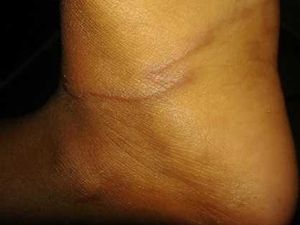 Kala Cacing Parasit Bersarang di Kaki Bocah Tak Bersandal