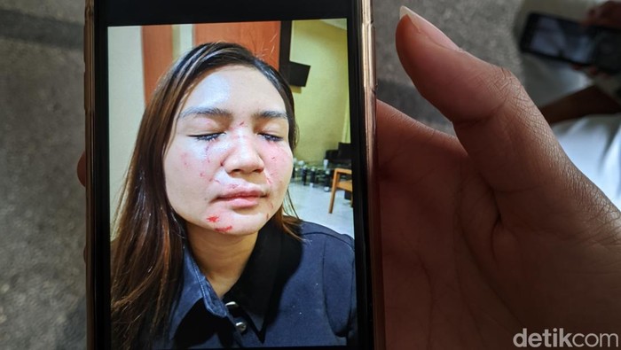 Penampakan wajah selebgram Dwita Qorina Agesti seusai diduga dianiaya mantan suami sirinya. (Ahmad Viqi/detikBali)