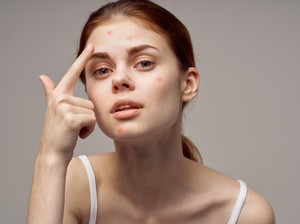 6 Cara Ampuh Menghilangkan Jerawat dalam Semalam