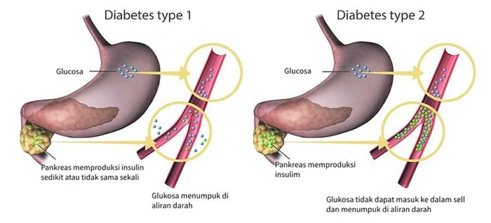 Glucoformin Obat Herbal Bantu Turunkan Kadar Gula Darah Diabetes
