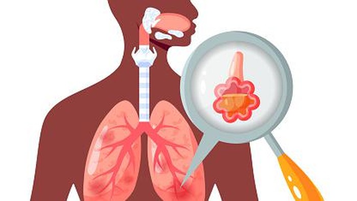 Ilustrasi paru-paru basah atau pneumonia.