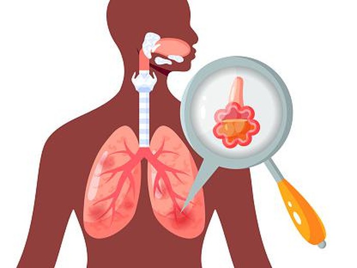 Ilustrasi paru-paru basah atau pneumonia.
