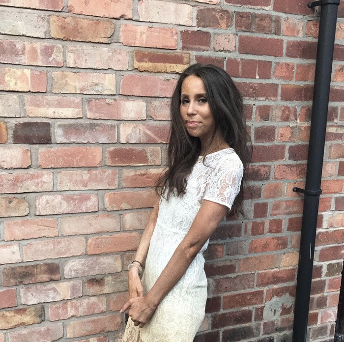 Wanita korban penyiraman air keras