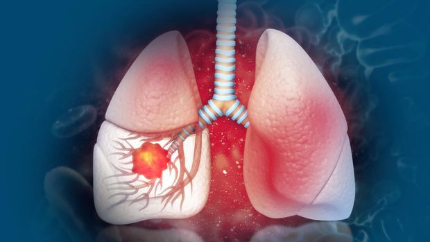 Lung cancer. lung disease