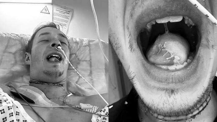 Kronologi Pria 26 Tahun Idap Kanker Mulut, Lidahnya Terpaksa Dipotong Sebagian