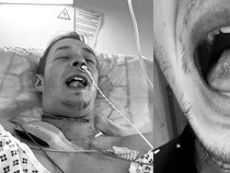 Kronologi Pria 26 Tahun Idap Kanker Mulut, Lidahnya Terpaksa Dipotong Sebagian