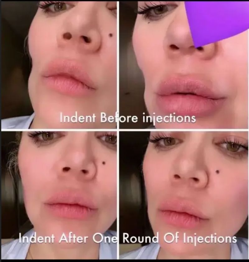 Khloe Kardashian Khloe Kardashian suntik filler pascoperasi tumor kulit.