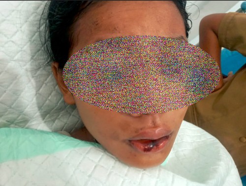 Meiya Chatelin Witak, siswi SMPN 1 Nubatukan, Lembata, yang terluka parah setelah disiram air keras oleh sepupunya, Charles Arif. (Istimewa)