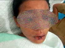 Mata Siswi SMP di Lembata yang Disiram Air Keras Alami Kerusakan Grade 4