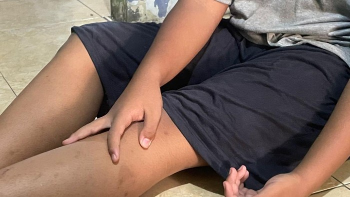 Kaki siswa SMP di Sidoarjo memar usai dihajar temannya