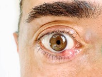 Kenali Kalazion, Benjolan di Kelopak Mata yang Mirip Bintitan