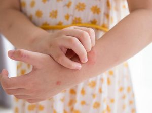 Eksim Bukan Penyakit Menular, Ini Penyebab dan Cara Mengatasinya
