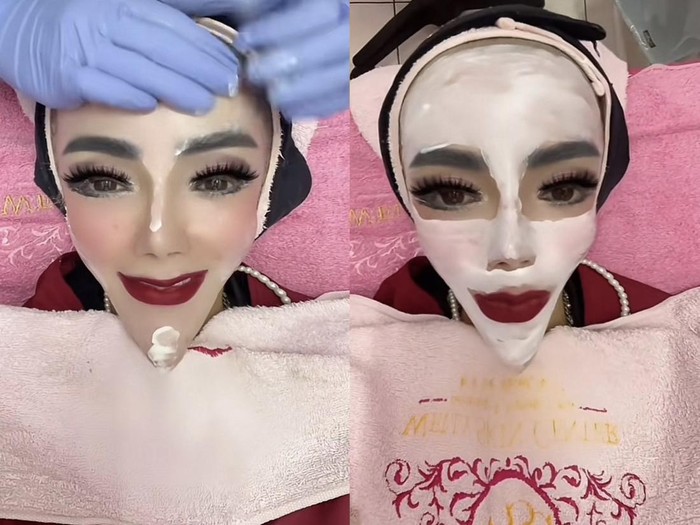 Wajah TikTokers Yuni Jasmine saat jalani perawatan.