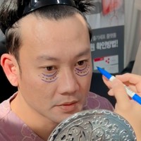 Untuk operasi kantung matanya Densu ditangani oleh dokter Im, salah satu dokter terbaik di bidangnya. Terlihat bagian bawah mata Densu ditandai terlebih dahulu sebelum tindakan. Foto: Instagram/@sumargodenny