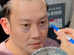 7 Foto Denny Sumargo Operasi Kantung Mata di Korea, Begini Hasilnya