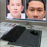 Wajah Densu juga dipotret untuk nantinya dibandingkan dengan hasil setelah operasi.  Foto: Instagram/@sumargodenny