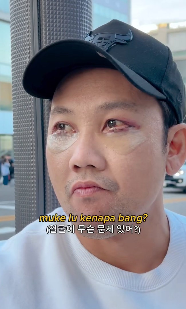 Dari unggahan yang dibagikannya terlihat jelas jahitan di daerah bawah mata Densu. Meski demikian dirinya sudah kembali aktif membuat konten dan berjalan-jalan keliling Korea. Foto: Instagram/@sumargodenny