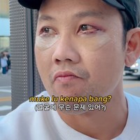 Dari unggahan yang dibagikannya terlihat jelas jahitan di daerah bawah mata Densu. Meski demikian dirinya sudah kembali aktif membuat konten dan berjalan-jalan keliling Korea. Foto: Instagram/@sumargodenny