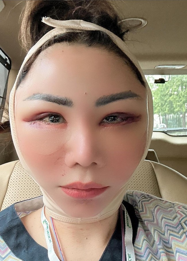 Prosedur yang dilakukan antara lain Ponytail lifting, LBC, baby stemcell for face, fat graft exo glow dan pore surgery. Foto: Instagram/@femmypermatasari