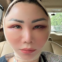 Prosedur yang dilakukan antara lain Ponytail lifting, LBC, baby stemcell for face, fat graft exo glow dan pore surgery. Foto: Instagram/@femmypermatasari