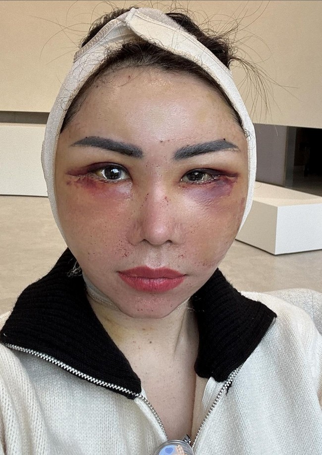 Femmy menjelaskan enam prosedur itu bertujuan untuk menarik garis smile line yang sudah dalam dan membuat muka lebih kencang, menarik kulit di bawah mata, mendapatkan kulit mulus bak kulit bayi, penambahan lemak di kening, membuat kulit berkilau dan mengecilkan pori-pori. Foto: Instagram/@femmypermatasari