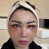 Femmy menjelaskan enam prosedur itu bertujuan untuk menarik garis smile line yang sudah dalam dan membuat muka lebih kencang, menarik kulit di bawah mata, mendapatkan kulit mulus bak kulit bayi, penambahan lemak di kening, membuat kulit berkilau dan mengecilkan pori-pori. Foto: Instagram/@femmypermatasari