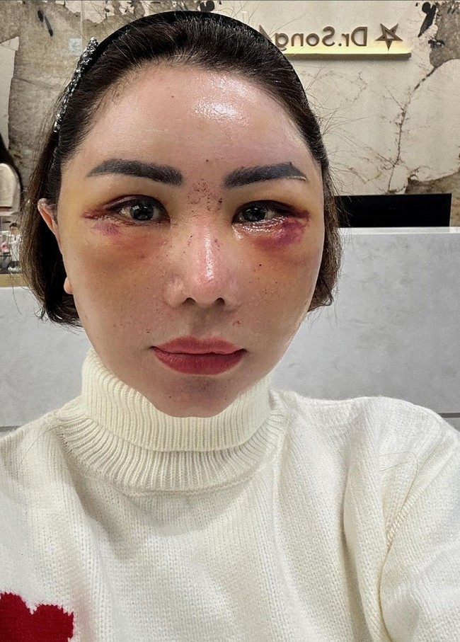 Femmy membagikan penampakan wajahnya dari hari pertama pascaoperasi hingga hari ke-10. Terlihat wajahnya bengkak dan penuh lebam, terutama di bagian mata. Foto: Instagram/@femmypermatasari