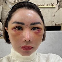 Femmy membagikan penampakan wajahnya dari hari pertama pascaoperasi hingga hari ke-10. Terlihat wajahnya bengkak dan penuh lebam, terutama di bagian mata. Foto: Instagram/@femmypermatasari