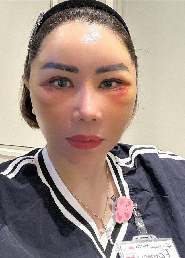 “Urutan Day 1 after PS sampai selanjutnya…. Yg namanya Paska Operasi pasti melalui tahap2 yg tidak nyaman & jelek dulu 😁 Karena penyembuhan semua melalui Tahap yg Alami bukan disulap 1 Jam lsng Jreng,” tulisnya pada caption foto. Foto: Instagram/@femmypermatasari