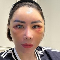 “Urutan Day 1 after PS sampai selanjutnya…. Yg namanya Paska Operasi pasti melalui tahap2 yg tidak nyaman & jelek dulu 😁 Karena penyembuhan semua melalui Tahap yg Alami bukan disulap 1 Jam lsng Jreng,” tulisnya pada caption foto. Foto: Instagram/@femmypermatasari