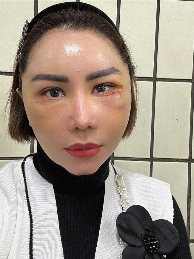 Seiring berjalannya hari, wajah Femmy yang sebelumnya bengkak dan terlihat aneh, berangsur-angsur membaik. Foto: Instagram/@femmypermatasari