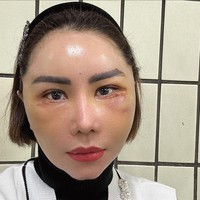 Seiring berjalannya hari, wajah Femmy yang sebelumnya bengkak dan terlihat aneh, berangsur-angsur membaik. Foto: Instagram/@femmypermatasari