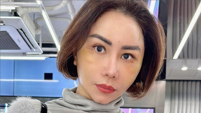 Femmy Permatasari Operasi Plastik.