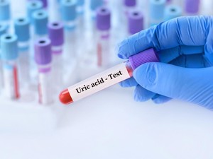 Kenali Gejala Asam Urat Tinggi, Penyebab, dan Faktor Risikonya