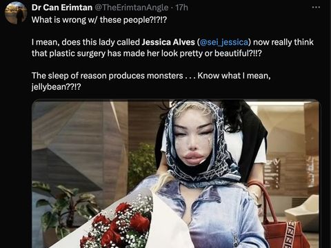 Jessica Alves setelah facelift kelima