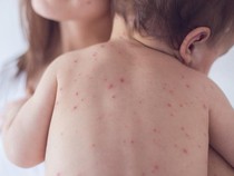 Coba Pakai Obat Tradisional Ini untuk Redakan Cacar Air