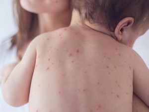 Waspada Cacar Air! Pakar Sarankan Perkuat Imun & Vaksinasi sebagai Solusi