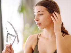 Apakah Bekas Jerawat Bisa Hilang Sendiri? Ini Faktanya