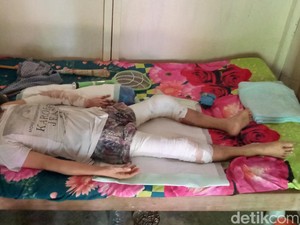 Pilu! Setahun Indra Tergolek di Kasur Akibat Luka Bakar Saat Padamkan Karhutla