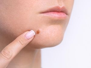 5 Cara Agar Jerawat Cepat Matang dengan Aman dan Efektif