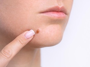 5 Cara Agar Jerawat Cepat Matang dengan Aman dan Efektif