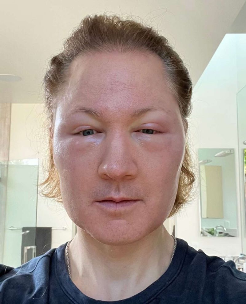 Bryan Johnson suntik lemak di wajah.